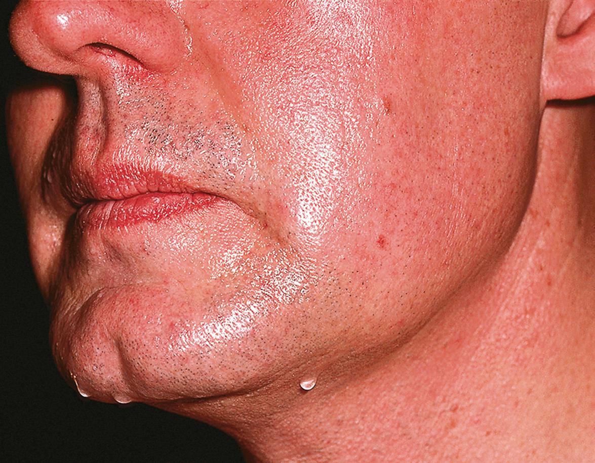 Fig. 39.1, Primary cortical (emotional) hyperhidrosis involving the face.