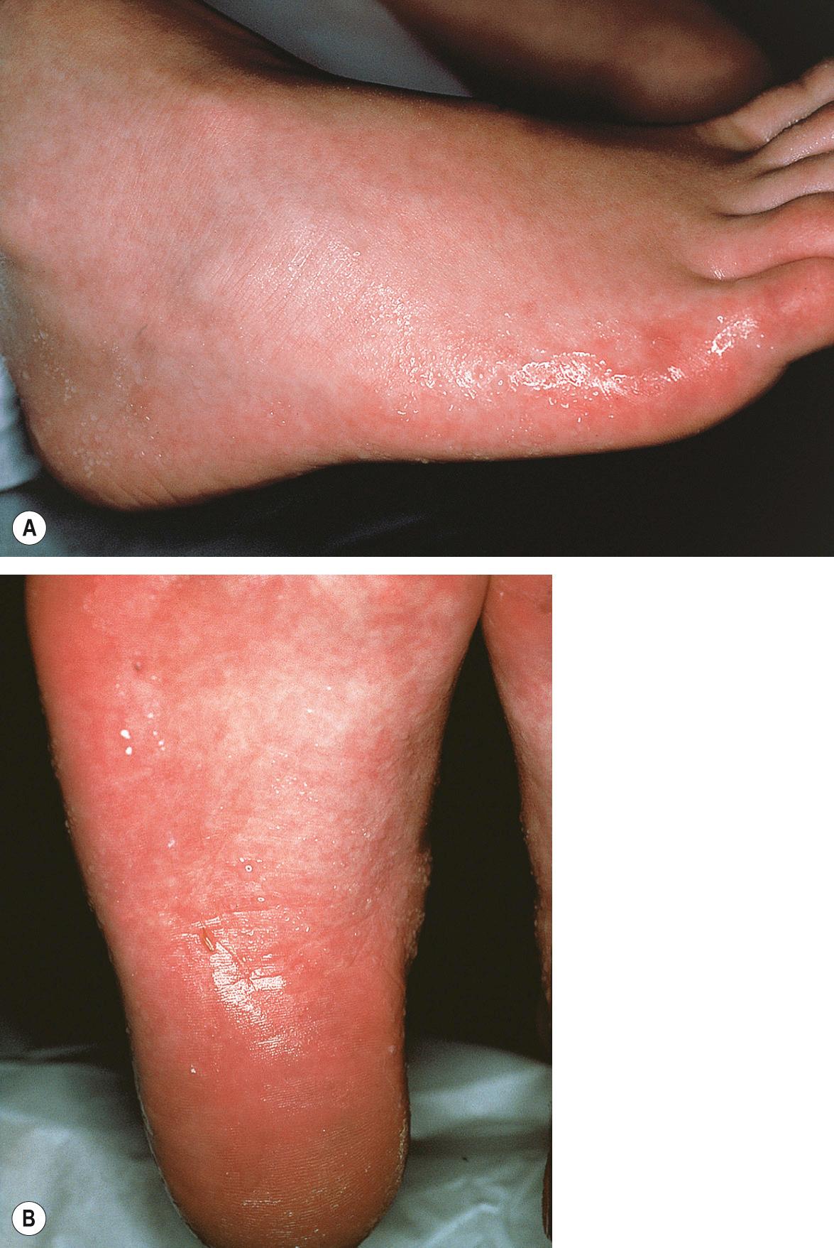 Fig. 39.2, Volar hyperhidrosis (primary cortical).