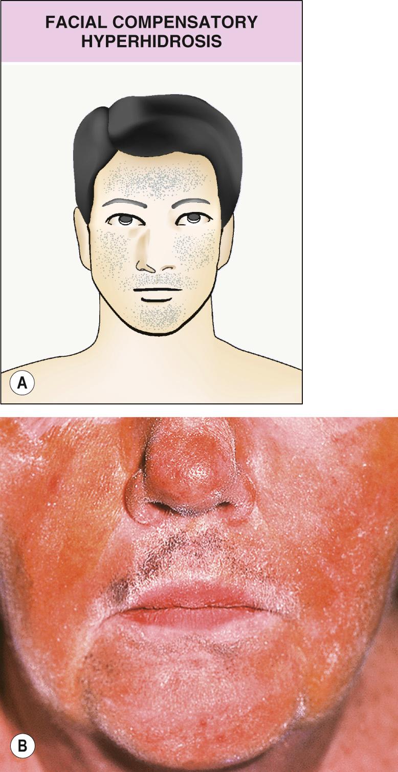 Fig. 39.4, Compensatory hyperhidrosis of the face.