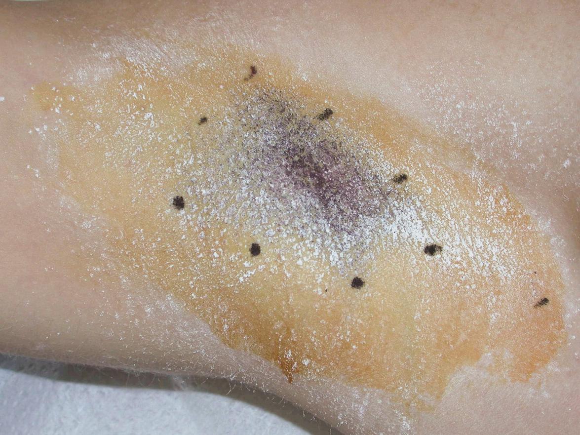 Fig. 39.6, Delineation of area for injections of botulinum toxin A for axillary hyperhidrosis (starch–iodine technique).