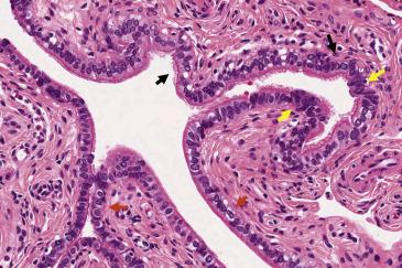 FIG. 12.1, Normal fallopian tube mucosa. A mixed population composed of ciliated cells (with appreciable brush border and eosinophilic apical bar; black arrow ), secretory cells (nonciliated, more basophilic cytoplasm, yellow arrows ), and peg cells (small round nuclei and scant cytoplasm, red arrows ) is appreciated.