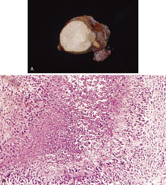 FIG. 12.12, Tuberculous salpingitis. The lesion appears as areas of cavitation contain caseating (“cheesy”) material (A). Microscopically, the infection produces a necrotizing granulomatous reaction, with necrotic debris surrounded by epithelioid histiocytes, giant cells, and lymphoplasmacytic infiltrates (B).