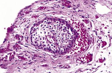 FIG. 12.2, Walthard nest in the tubal serosa. It appears as a well-defined cluster of stratified epithelium resembling urothelium.