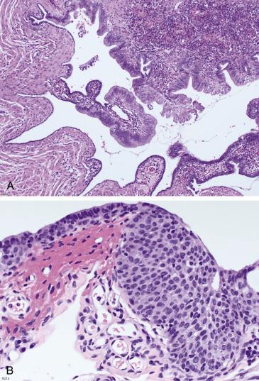 FIG. 12.3, Epithelial metaplasia of the fallopian tube. The most common is mucinous metaplasia, seen as simple epithelium with abundant apical mucinous cytoplasm partially replacing the normal tubal epithelium (A). Transitional metaplasia involving the tubal mucosa features epithelial stratification and ovoid nuclei with grooves (B).