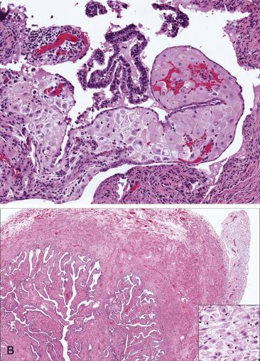 FIG. 12.4, Decidual change. Decidual change involving the submucosal stroma and mildly expanding the plica (A). Ectopic decidua in the tubal serosa (B, upper right ; high magnification in inset ).