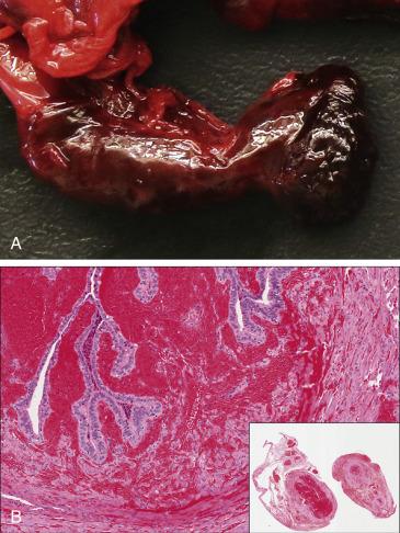 FIG. 12.5, Tubal torsion. Macroscopically, it is seen as a diffusely congested and hemorrhagic tube (A). Tubal torsion leads to extensive hemorrhagic necrosis, more pronounced in the submucosa (B). The extent of the hemorrhage is better seen at scanning magnification (inset) .