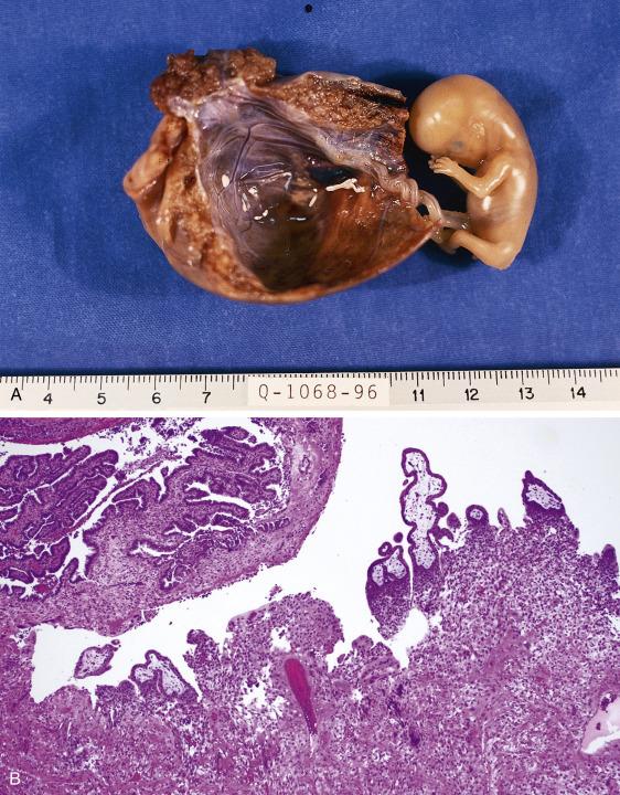 FIG. 12.7, Ectopic pregnancy. Grossly, the tube is hemorrhagic and distended, containing a gestational sac and a well-formed fetus, which is a rare finding (A). Microscopically, chorionic villi and implantation site trophoblast can be observed attached to the tubal wall (B).