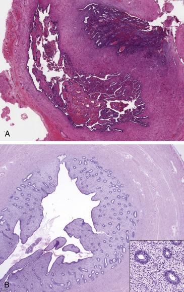 FIG. 12.8, Endometriosis. This disorder often involves the tubal serosa and outer wall (A). A slightly different phenomenon, in which the endometrium replaces the proximal tubal mucosa (“endometrialization”), can be considered another form of endometriosis (B). High power view demonstrates endometrial-type glands and stroma (inset).