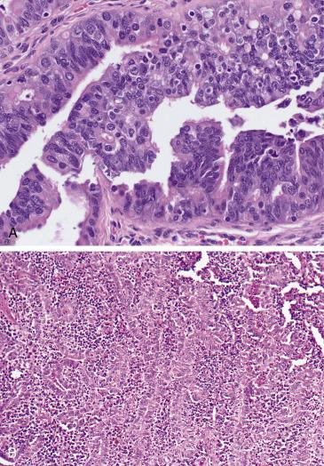 FIG. 12.9, Florid epithelial hyperplasia. Hyperplasia characterized by epithelial thickening, more prominent nuclear stratification and narrowing of the lumen. It can be mild and localized (A) or quite exuberant mimicking carcinoma (pseudocarcinomatous hyperplasia), often in a background of dense inflammation (B).