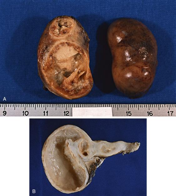 FIG. 12.10, Infectious nongranulomatous salpingitis. This disorder is associated with enlargement, congestion and edema of the wall, as well as accumulation of purulent material in the lumen (A) and subsequent cystic dilation (B).