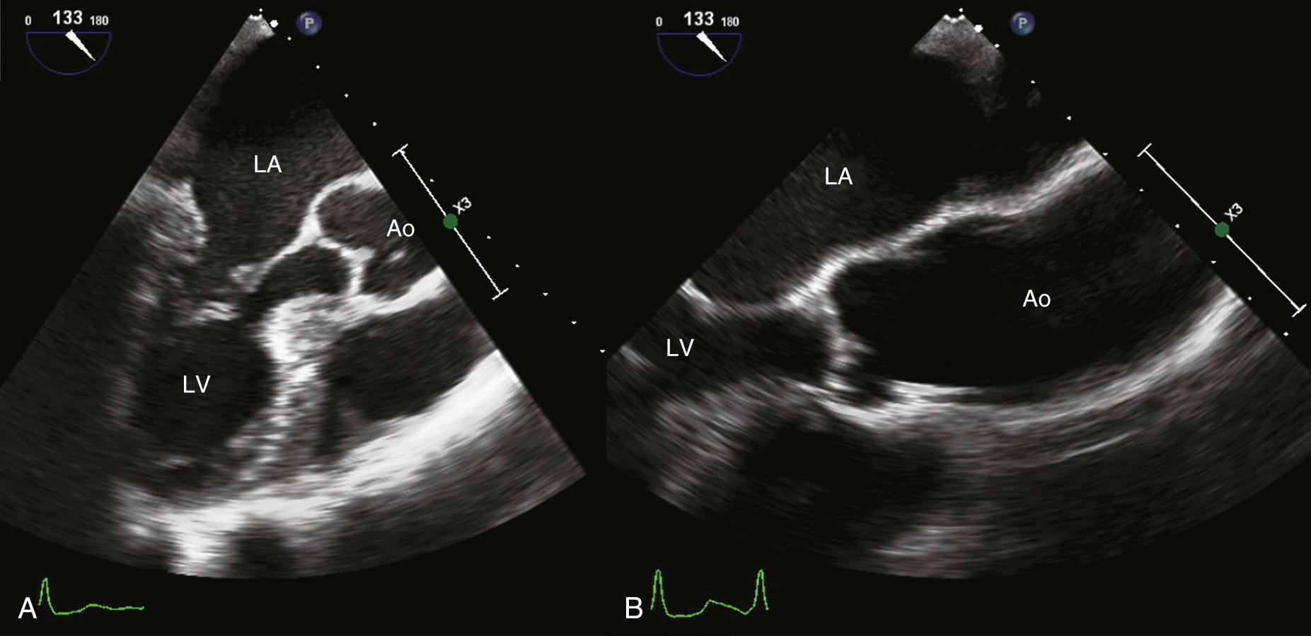 Fig. 16.11, TEE imaging of the ascending aorta.