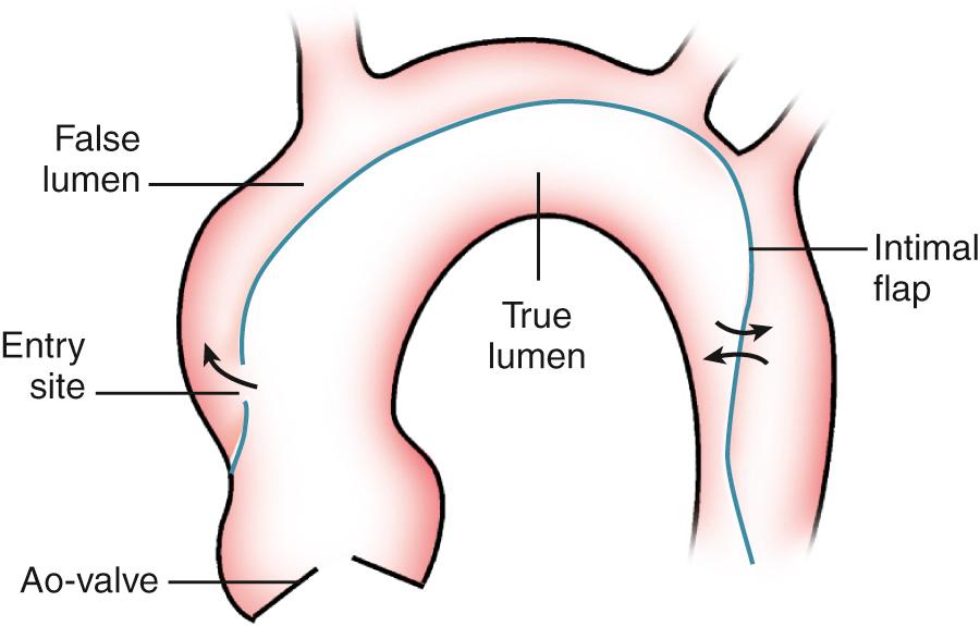 Fig. 16.2, Schematic diagram of an aortic dissection.