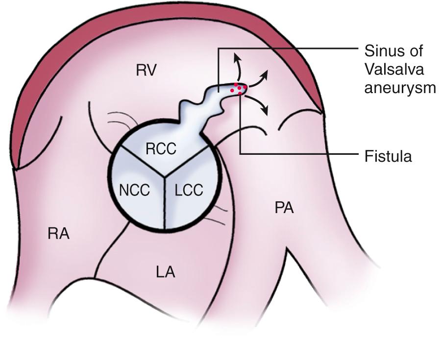 Fig. 16.3, Schematic diagram of a congenital sinus of Valsalva aneurysm.