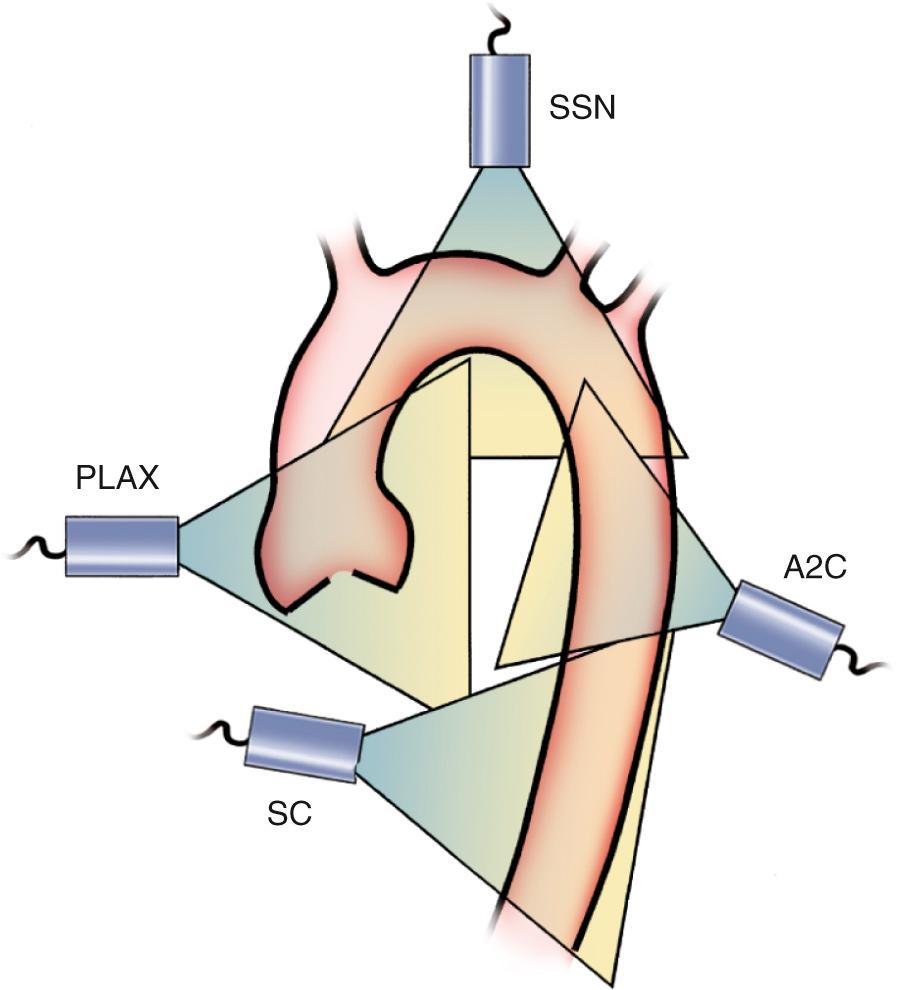 Fig. 16.4, Evaluation of the aorta from a transcutaneous approach.