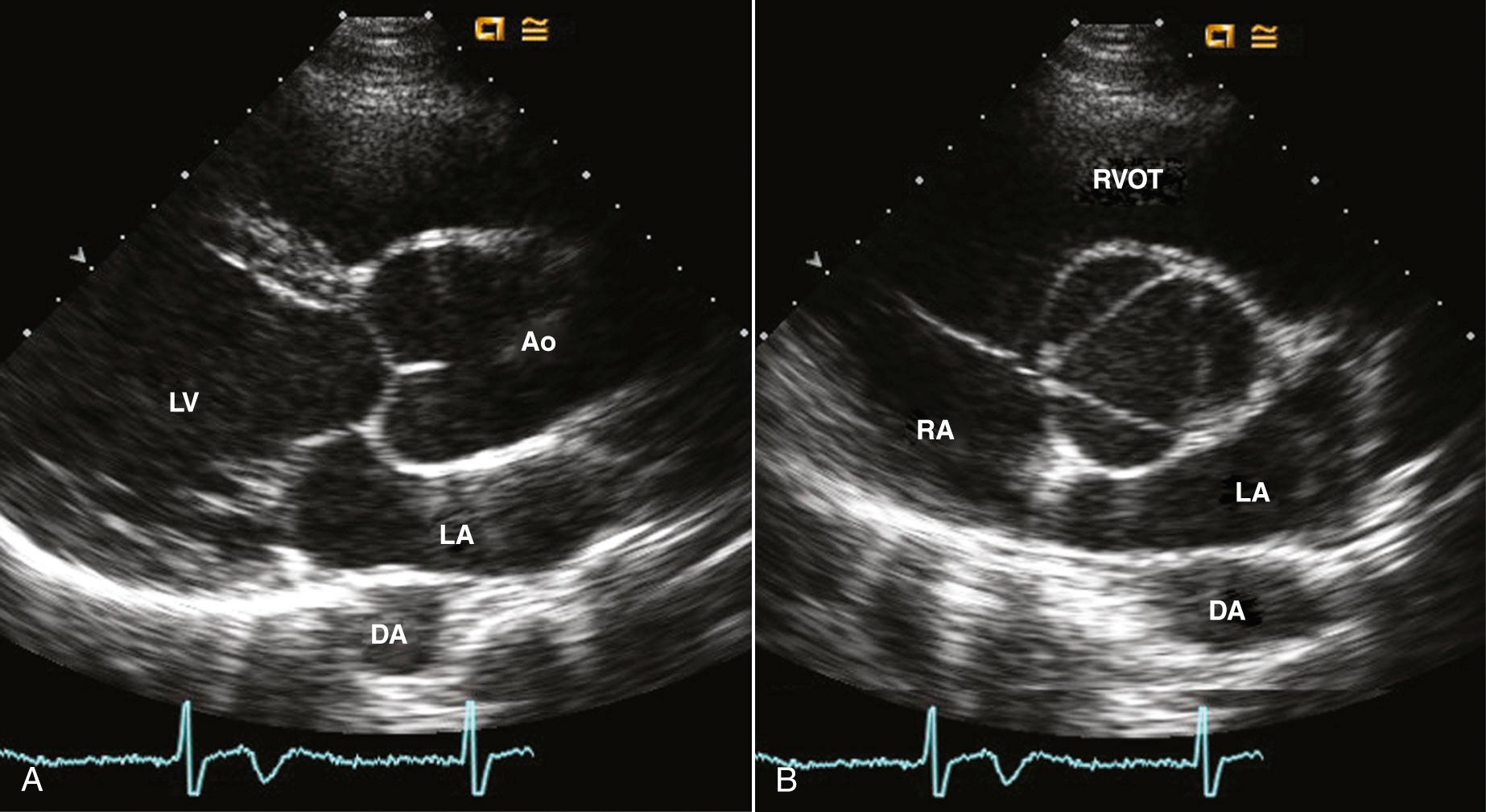 Fig. 16.5, Marfan syndrome.