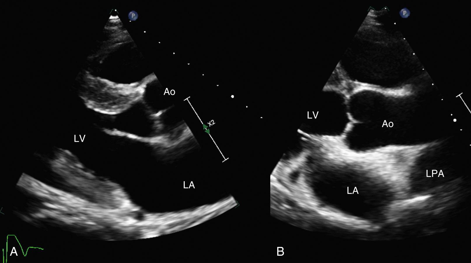 Fig. 16.6, Imaging the ascending aorta.
