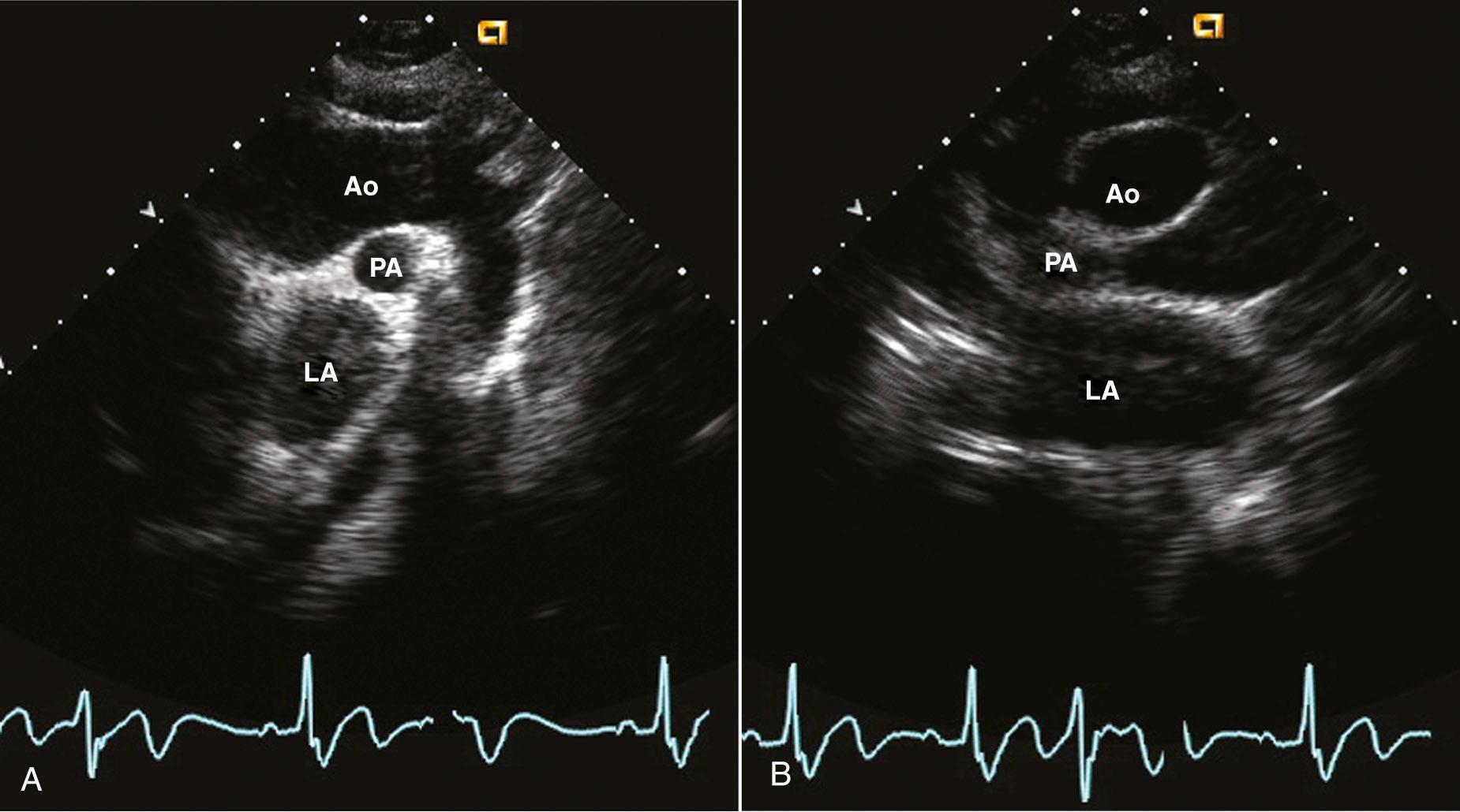 Fig. 16.7, Suprasternal notch view of the aorta.