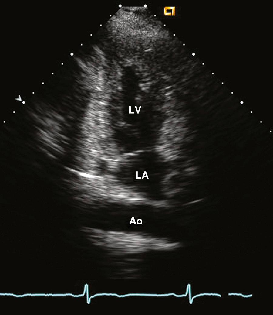 Fig. 16.8, Descending thoracic aorta.