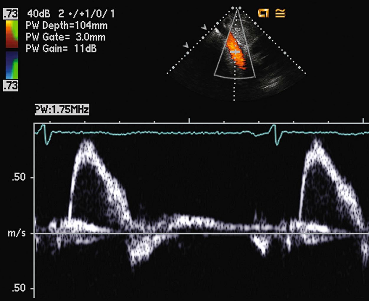 Fig. 16.10, Normal flow pattern in the proximal abdominal aorta.