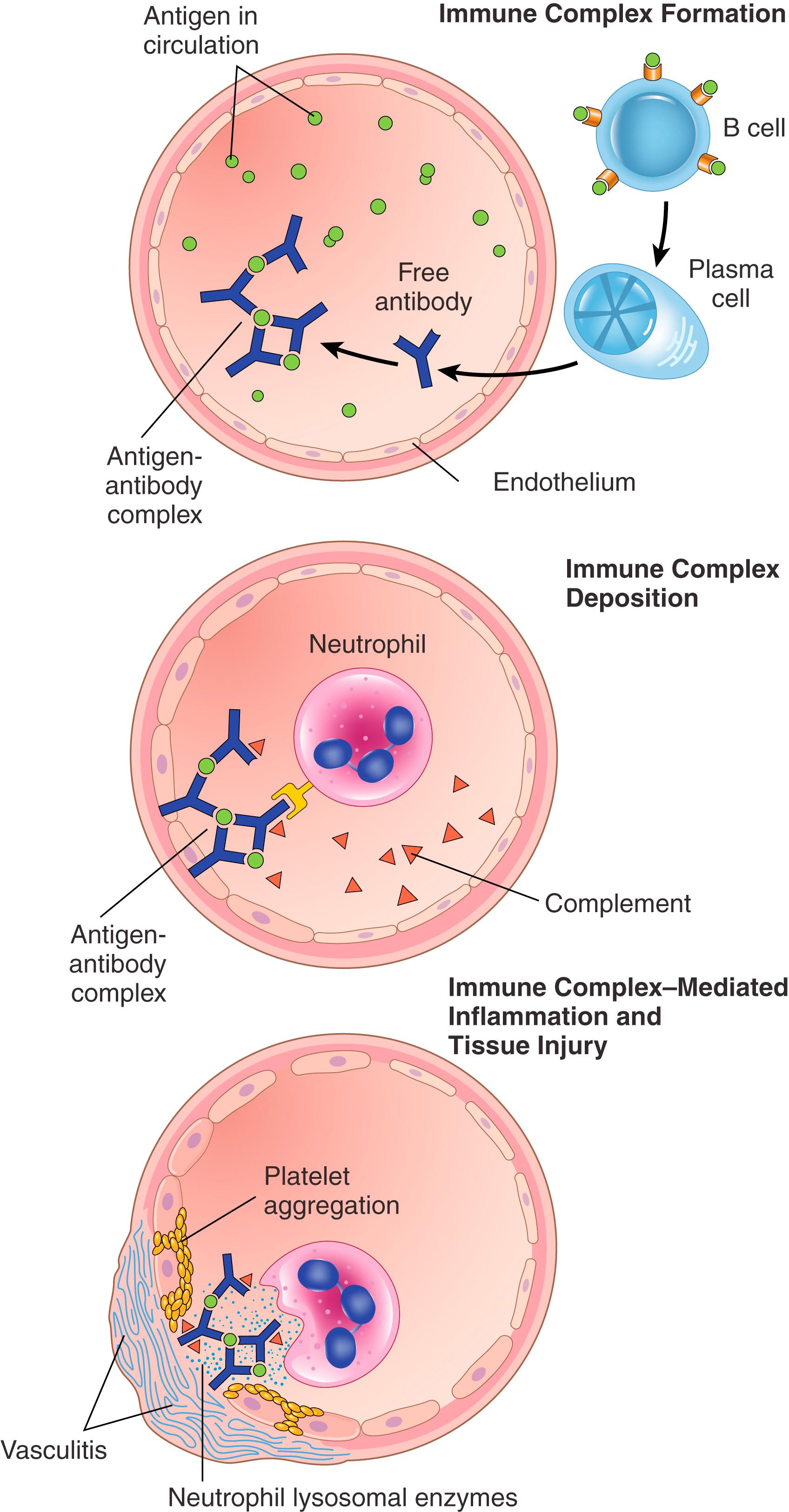 FIG. 5.13, Immune complex disease. The sequential phases in the induction of systemic immune complex–mediated diseases (type III hypersensitivity).