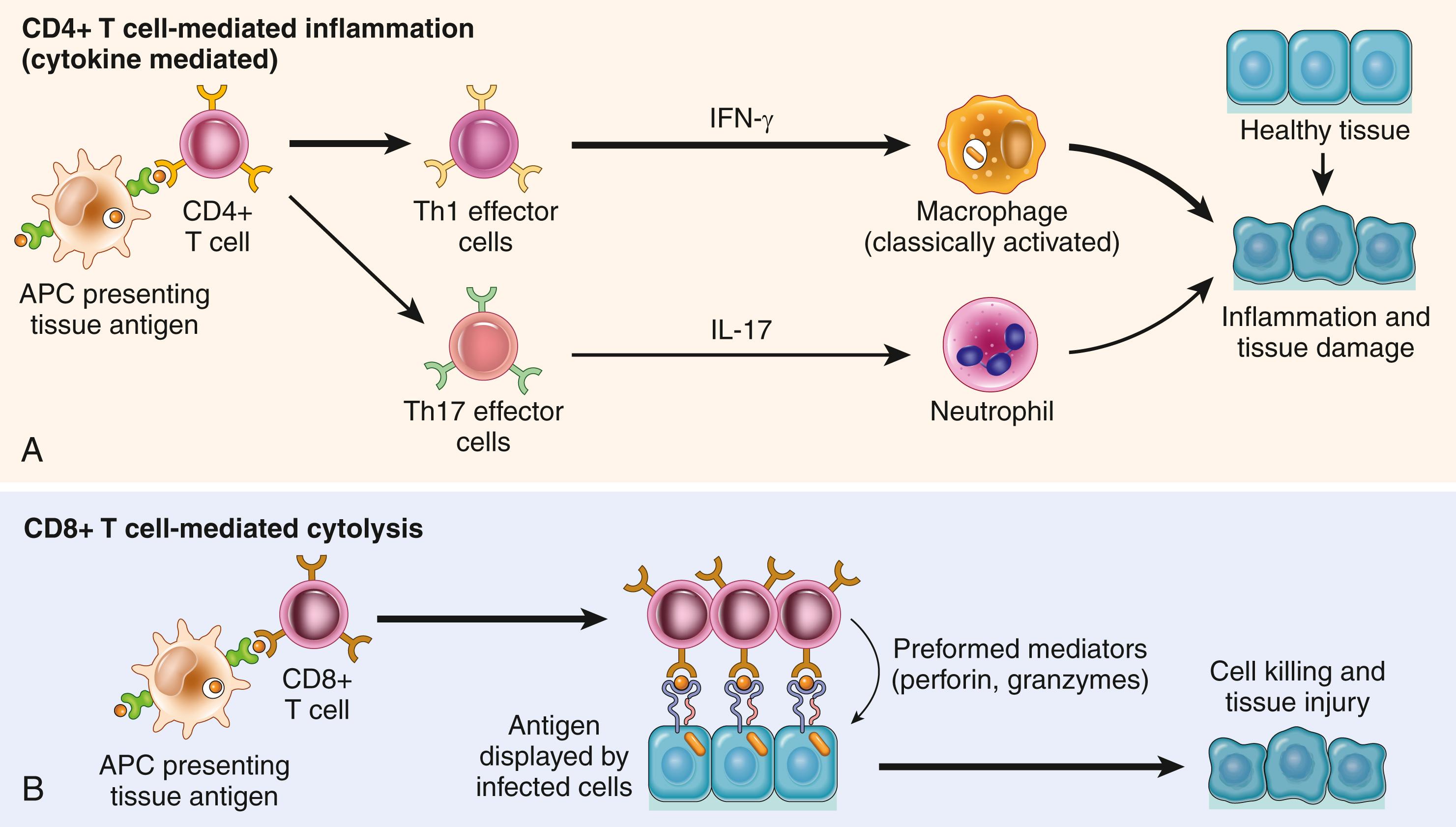 FIG. 5.14, Mechanisms of T cell–mediated (type IV) hypersensitivity reactions. (A) CD4+ Th1 cells (and sometimes CD8+ T cells, not shown ) respond to tissue antigens by secreting cytokines that stimulate inflammation and activate phagocytes, leading to tissue injury. CD4+ Th17 cells contribute to inflammation by recruiting neutrophils (and, to a lesser extent, monocytes). (B) In some diseases, CD8+ cytotoxic T lymphocytes (CTLs) directly kill tissue cells expressing intracellular antigens (shown as orange bars inside cells). APC, Antigen-presenting cell.