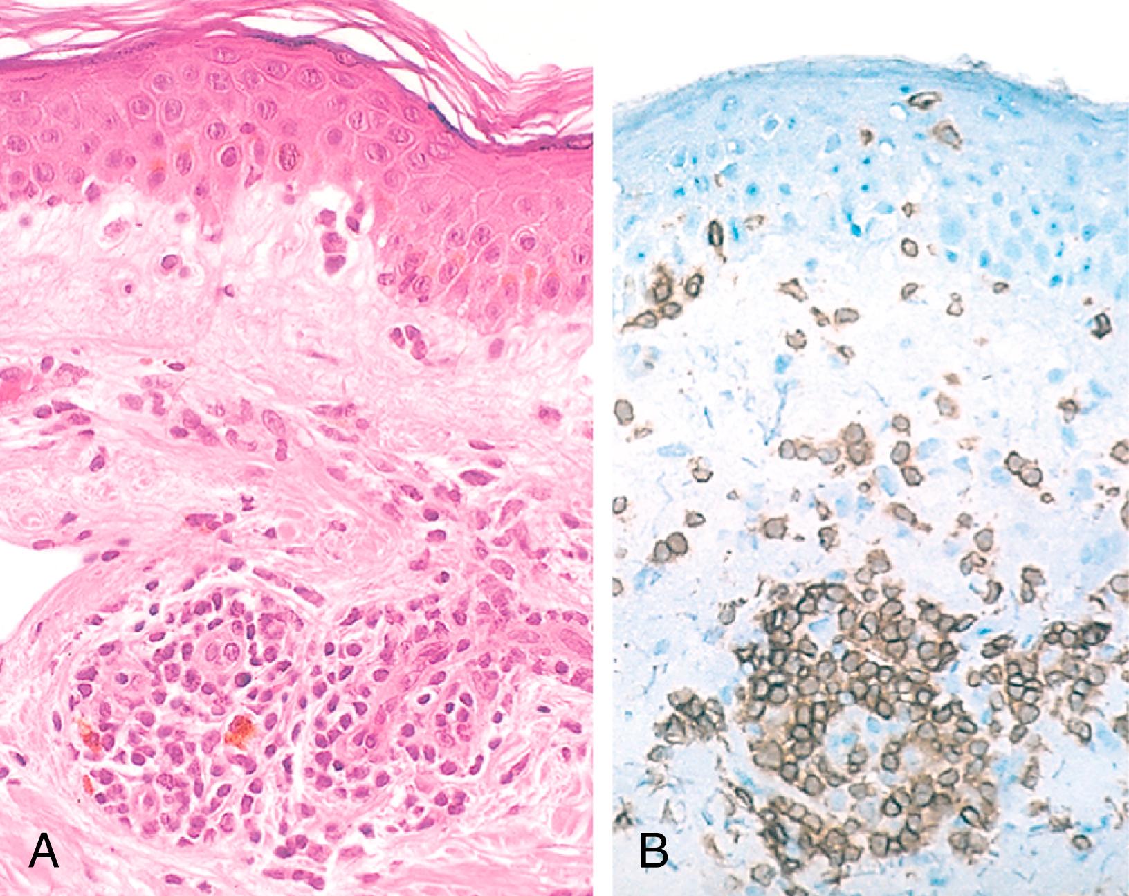 FIG. 5.15, Delayed hypersensitivity reaction in the skin. (A) Perivascular accumulation (“cuffing”) of mononuclear inflammatory cells (lymphocytes and macrophages), with associated dermal edema and fibrin deposition. (B) Immunoperoxidase staining reveals that the perivascular infiltrate consists mainly of CD4+ T cells.