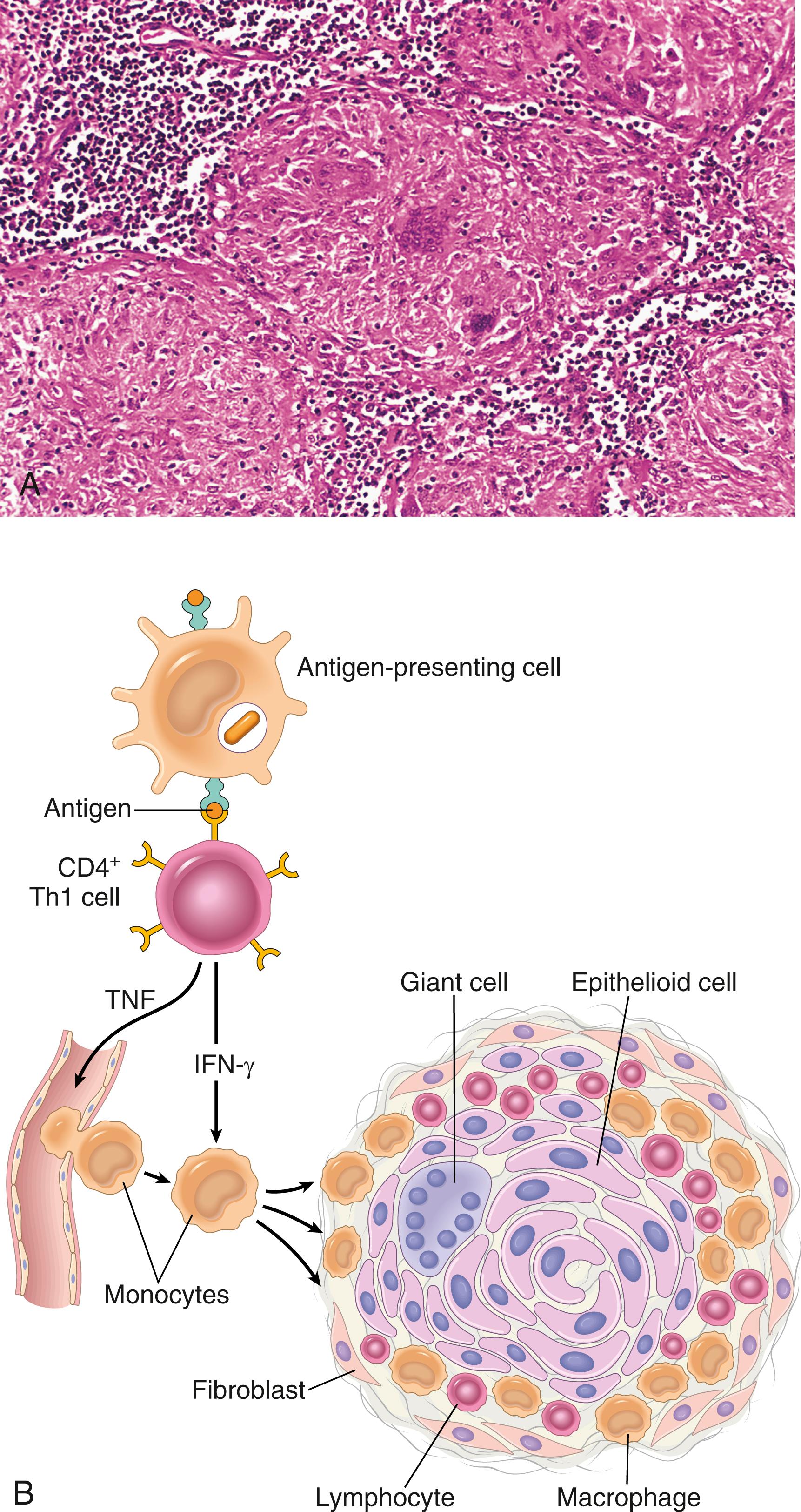 eFIG. 5.1, Granulomatous inflammation. (A) A section of a lymph node shows several granulomas, each made up of an aggregate of epithelioid cells and surrounded by lymphocytes. The granuloma in the center shows several multinucleate giant cells. (B) The events that give rise to the formation of granulomas in type IV hypersensitivity reactions, illustrating the role of Th1 cytokines. In some granulomatous disorders (e.g., schistosomiasis), Th2 cells also contribute to the lesions.