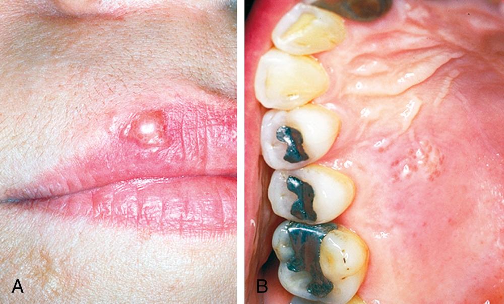 FIGURE 393-2, Clusters of recurrent herpes simplex vesicles.