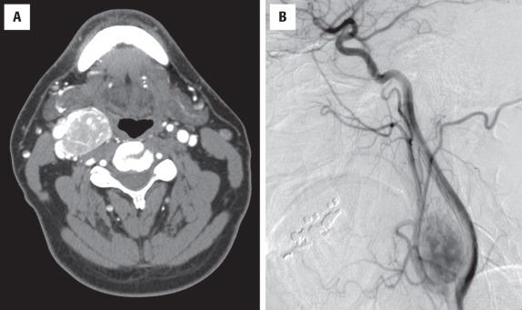 FIGURE 29.1, ( A ) Contrast-enhanced computed tomography scan demonstrates a large enhancing mass at the bifurcation of the carotid artery on the left. ( B ) Angiography demonstrates splaying of the internal and external carotid arteries by a well-vascularized tumor.