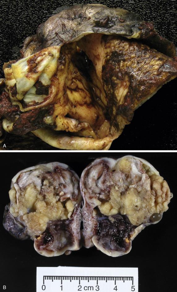 FIG. 18.1, (A) Endometriotic cyst. A large cyst shows an ulcerated and partly hemorrhagic lining and an irregularly thickened wall with surface adhesions. (B) Endometrioid carcinoma arising in an endometriotic cyst. A large, multinodular, fungating white to tan mass originates within the cyst wall and replaces the cyst.