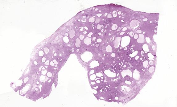 FIG. 18.11, Polypoid endometriosis. In contrast to Müllerian/mesodermal adenosarcoma, no intraglandular stromal protrusions or stromal condensation is seen.