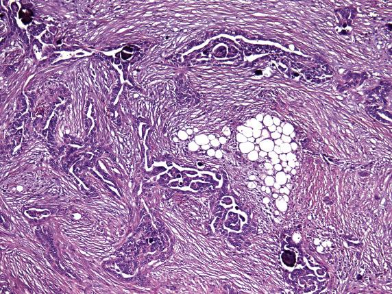 FIG. 18.13, High-grade serous carcinoma of peritoneum. Poorly formed glands with slit-like morphology are infiltrating the adipose tissue and associated with striking desmoplastic response.