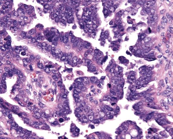 FIG. 18.14, High-grade serous carcinoma of peritoneum. Poorly formed, irregularly shaped papillae are lined by pseudostratified epithelium with nonpolarized, hyperchromatic, and pleomorphic nuclei.