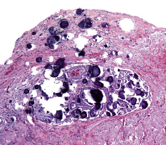 FIG. 18.16, Serous borderline tumor of peritoneum. A well-defined cyst contains multiple papillary structures associated with psammoma bodies. The appearance is identical to a noninvasive epithelial implant from ovarian serous borderline tumor.