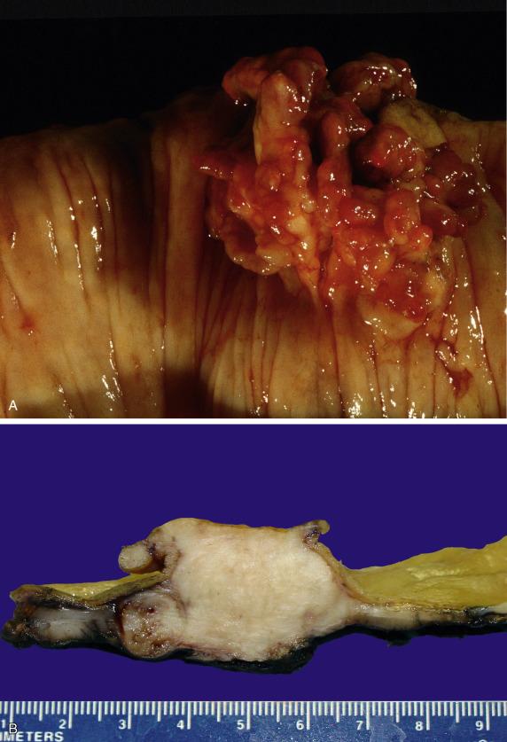 FIG. 18.2, A. Polypoid endometriosis in colon. A large, exophytic, soft, and hemorrhagic mass grows into the colon lumen (Courtesy Dr. Robert Young, Massachusetts General Hospital.) B. Low-grade adenosarcoma in bowel wall. A poorly defined, white, solid, and soft mass infiltrates and distorts the wall of the large bowel.