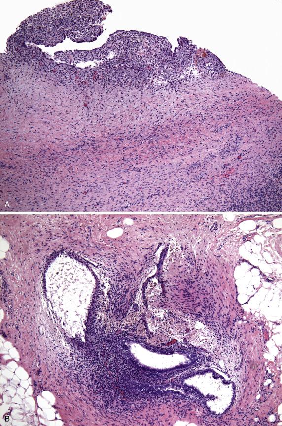 FIG. 18.3, (A) Endometriotic cyst. The cyst wall is thickened with associated fibrosis. Closer to the cyst lining, a “blue” band of endometrial stromal cells associated with recent hemorrhage is noted. Part of the endometrial epithelial lining is denuded. (B) Endometriosis of peritoneum. The diagnostic triad of endometrial-type epithelium, endometrial-type stroma, and evidence of old hemorrhage (hemosiderin-laden macrophages) is present.