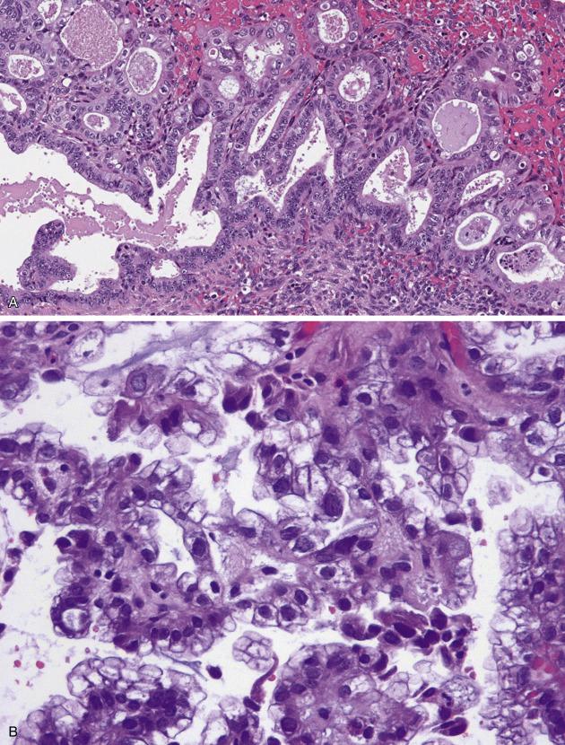 FIG. 18.6, Glandular neoplasia arising in endometriosis. The spectrum includes endometrioid neoplasia (A, in this case bordering on endometrioid carcinoma), and clear cell carcinoma (B).