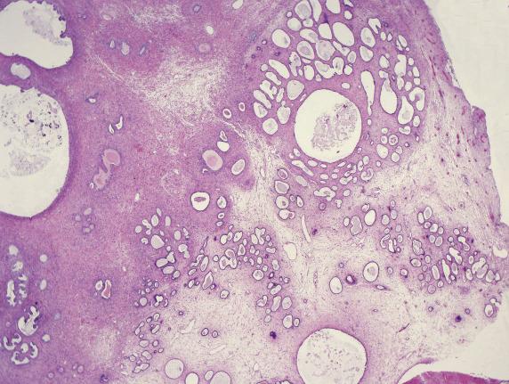 FIG. 18.8, Low-grade adenosarcoma. Condensation of neoplastic stroma around glands (left) is juxtaposed to polypoid endometriosis with hypocellular edematous stroma (right) .