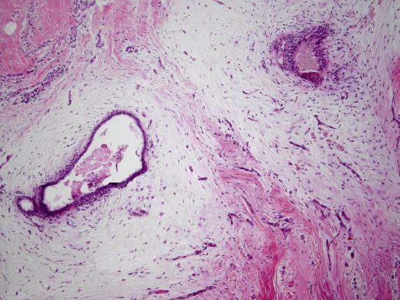 FIG. 18.9, Endometriosis with extensive stromal elastosis and myxoid change. Notice the small arterioles contained in the elastotic stroma.