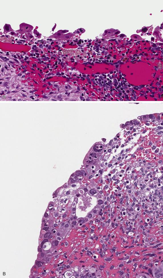 FIG. 18.10, Endometriotic cyst with reactive surface epithelial changes including enlarged nuclei with a smudgy appearance and inconspicuous nucleoli; note the abundant cytoplasm (A). Sometimes, nuclear enlargement and atypia are more prominent (B); in the absence of architectural complexity, this spectrum of atypia represents at most “atypical endometriosis.”