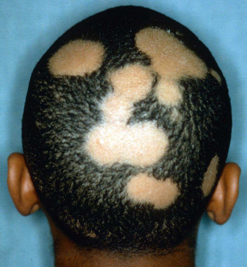 Fig. 33.1, Alopecia areata.