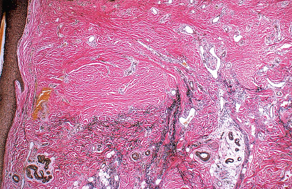 Fig. 33.11, Scarring alopecia (elastic stain). Normal elastic fibers (black) indicate the nonscarred portions of the dermis.