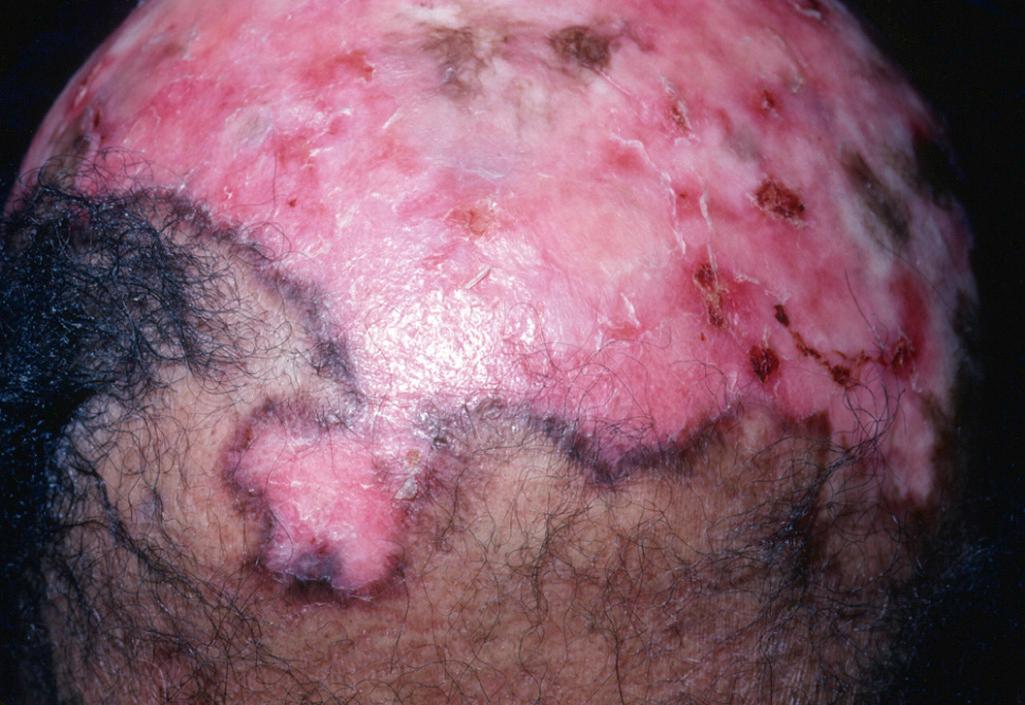 Fig. 33.12, Discoid lupus erythematosus.