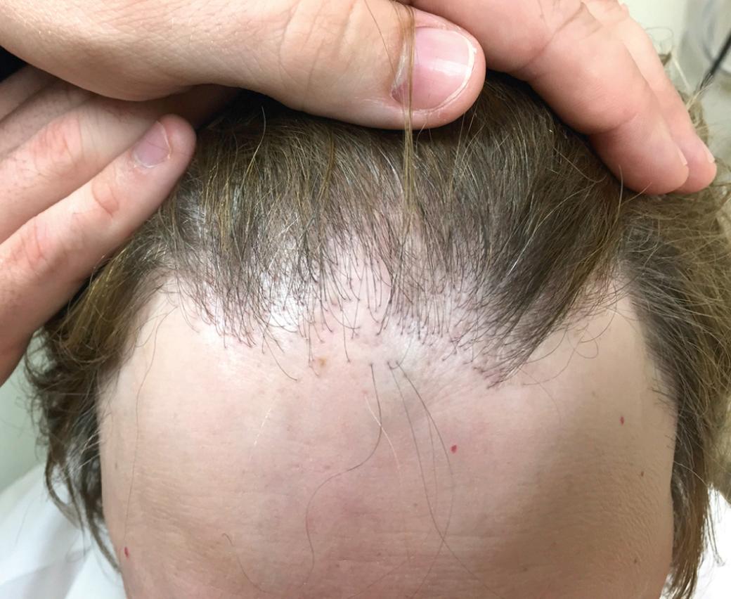 Fig. 33.13, Frontal fibrosing alopecia.