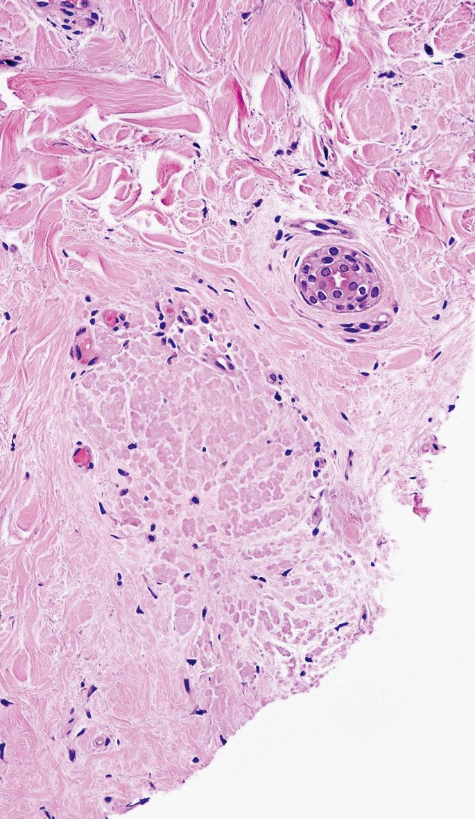 Fig. 33.14, Lichen planopilaris. Note cytoid bodies completely filling the fibrous tract remnant.