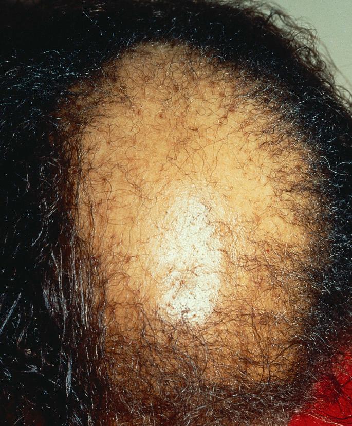 Fig. 33.15, Central centrifugal cicatricial alopecia.