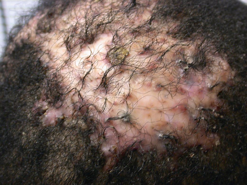 Fig. 33.16, Folliculitis decalvans.