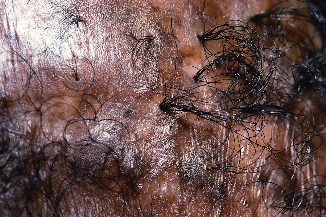 Fig. 33.18, Tufted doll's hairs, cicatricial alopecia.