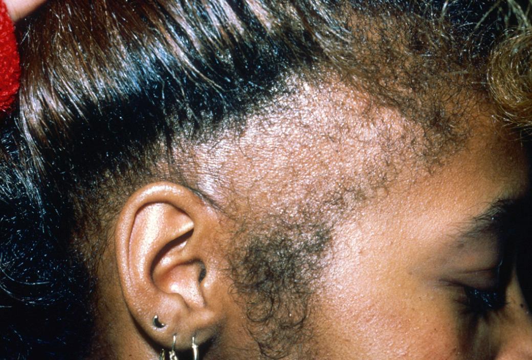 Fig. 33.19, Traction alopecia.