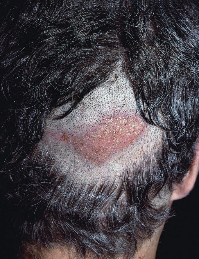 Fig. 33.20, Pressure alopecia with scalp demonstrating pressure-induced geometric pressure necrosis.